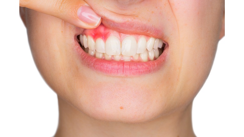 Immagine di infezione dentale