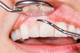 Immagine di bocca con infezioni dentale