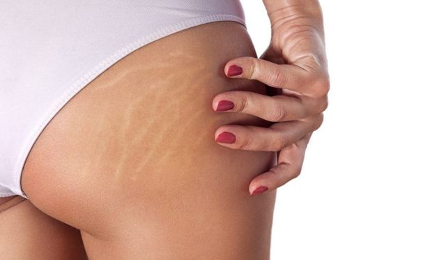 I costi per eliminare le smagliature con la biodermogenesi dipendono dalla durata del trattamento.