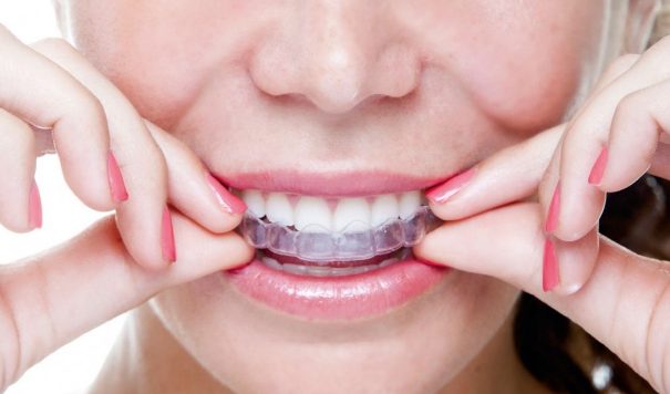 il costo di un bite dipende dalla sua tipologia.