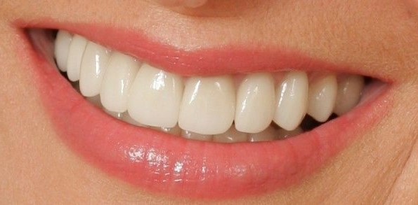 I prezzi per una corona dentale a Roma si oscillano tra 150 e 850 euro per singola unità.