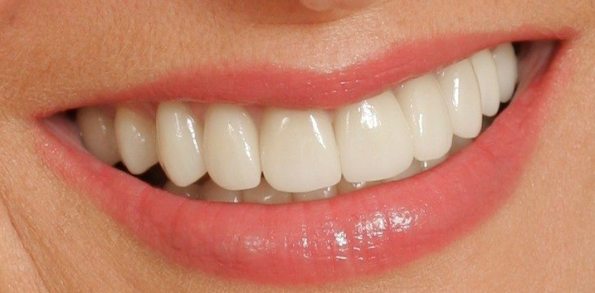 Il costo delle corone dentali varia in base al materiale.