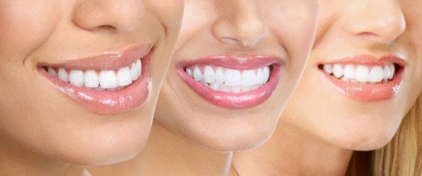 I costi per la correzione del sorriso gengivale dipendono dal tipo di trattamento scelto.