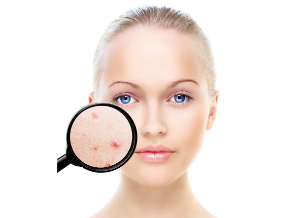 Esistono diversi rimedi contro lo acne e i costi sono differenti.