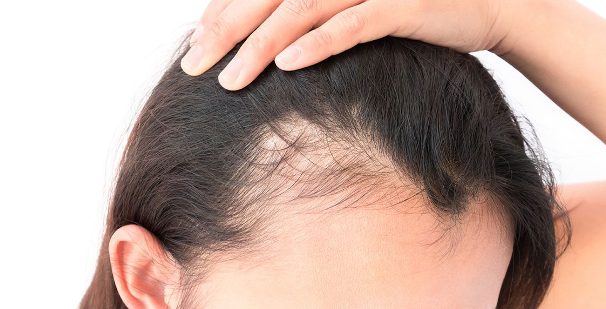 Una guida ai rimedi, con relativi costi, volti alla cura della alopecia.