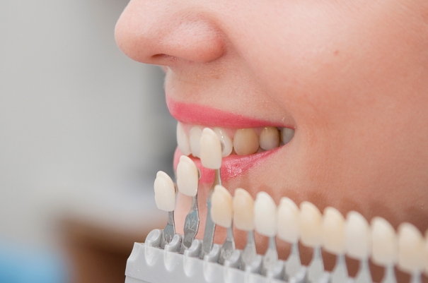 Il costo per delle faccette dentali dipende dai materiali e dal costo del dentista.