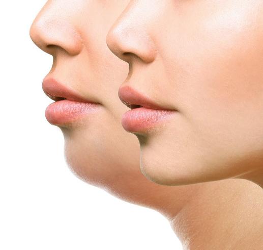 Per conoscere il costo di una intralipoterapia è opportuno richiedere più consulti medici