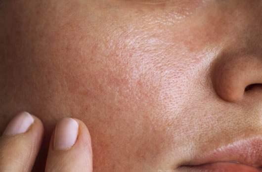 Il costo per un trattamento laser per lo acne dipende dal numero di sedute e dal fine del trattamento.