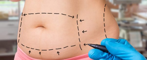 I prezzi di riferimento per chi vuole fare una liposuzione addominale a Lecce.