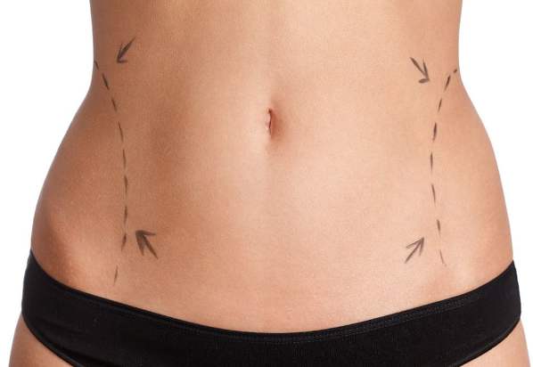 Il costo per una liposuzione laser addominale a Bergamo costa fra i 945 e i 2.493 euro.