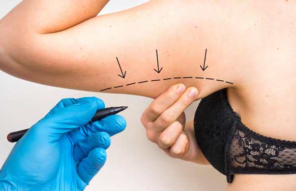 Una guida con i prezzi per una liposuzione laser a Lecce.