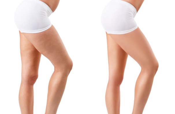 Per conoscere i costi di una liposuzione ai polpacci è opportuno richiedere più consulti medici.