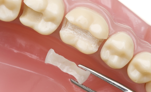 Una otturazione di un dente ha un costo variabile in base al dentista e ai materiali usati.