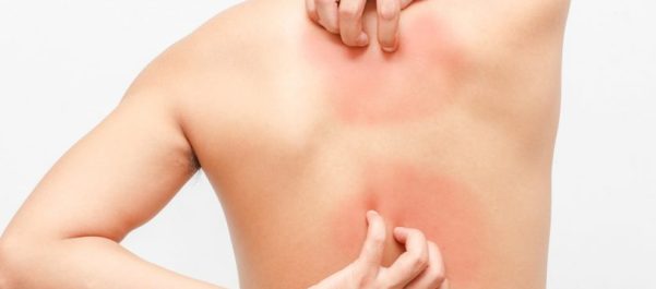 Una guida ai rimedi, con i relativi costi, per trattare la psoriasi.