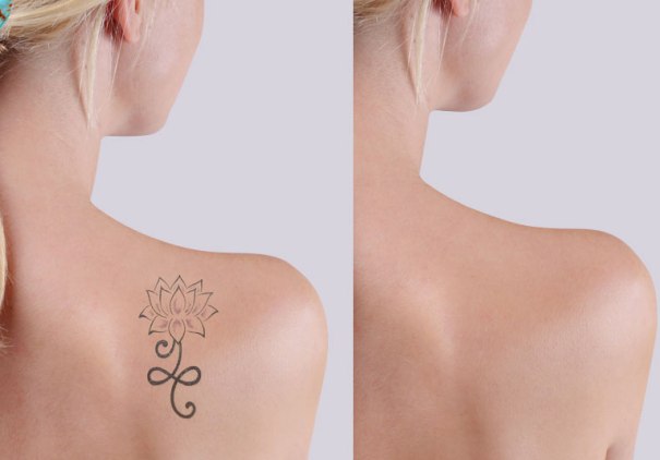 Tutto quello che serve per sapere quanto costa la rimozione di tatuaggi a Latina.