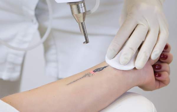 Una guida che mostra quanto costa la rimozione di tatuaggi a Milano.