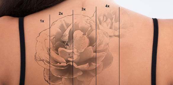 Il costo per la rimozione di un tatuaggio a Palermo dipende dal tipo di tecnica scelta e dal numero di sedute.
