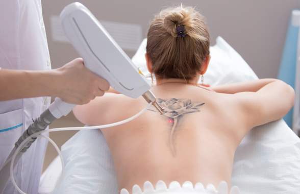 Il costo per la rimozione di un tatuaggio a Napoli parte dai 137,00 - 434,00 euro, se si sceglie la tecnica della dermoabrasione.