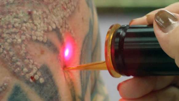 Il costo per la rimozione di un tatuaggio a Parma dipende dal numero di sedute richieste e dalla tecnologia utilizzata.