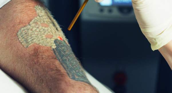 Informazioni sul costo per la rimozione di un tatuaggio a Torino.