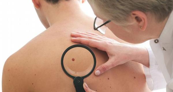 Per sapere qual è il costo per togliere un neo è opportuno richiedere più pareri medici