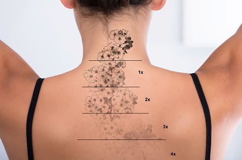 I costi per togliere un tatuaggio a Padova possono andare dai 136,00 ai 4.672,00 euro, in base a tecnica scelta e dimensioni del tatuaggio.