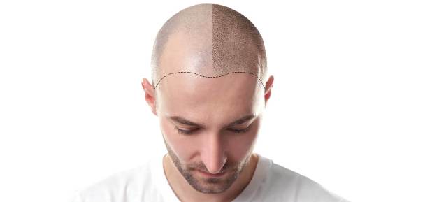 Una guida che spiega il costo di un trapianto di capelli a Bergamo.