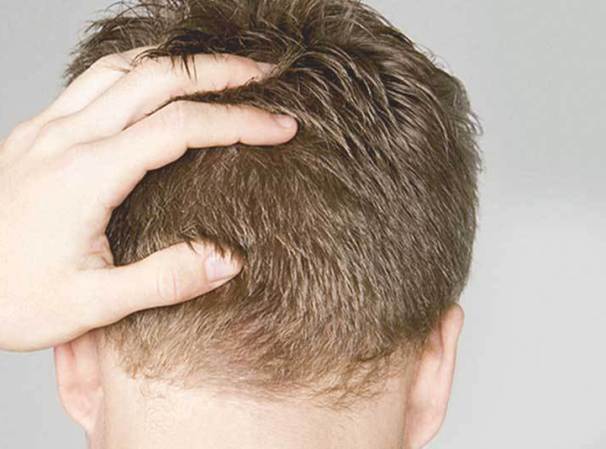 Tutto quello che si deve sapere sul costo del trapianto di capelli a Reggio Emilia.