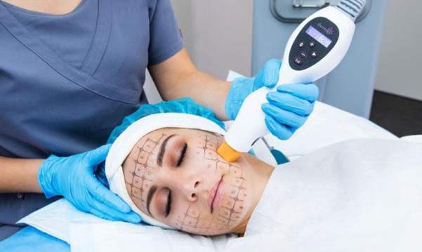 I costi di riferimento per un trattamento Thermage.