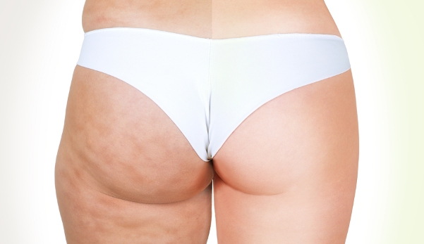 I costi per un trattamento Velashape dipendono dalle dimensioni della superficie da trattare.